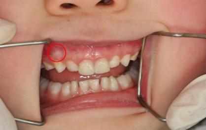 孩子牙疼吃点消炎药几天就能好,孩子牙疼吃消炎药