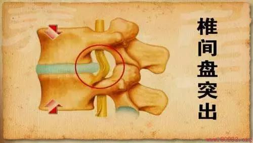 腰突导致腰肌劳损怎么治疗,腰肌劳损的保守治疗方法是什么