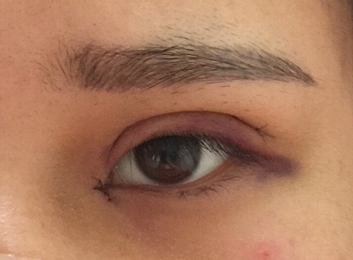 内双可以做埋线双眼皮整个过程,内双做埋线双眼皮会变成三眼皮吗