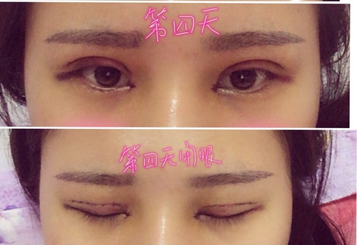 内双可以做埋线双眼皮整个过程,内双做埋线双眼皮会变成三眼皮吗