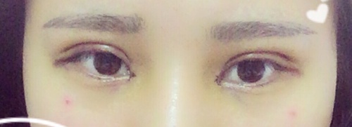 内双可以做埋线双眼皮整个过程,内双做埋线双眼皮会变成三眼皮吗