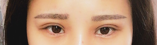 内双可以做埋线双眼皮整个过程,内双做埋线双眼皮会变成三眼皮吗