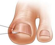 嵌甲，小病中的大智慧