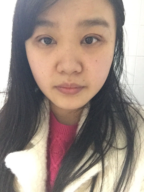 全切双眼皮感觉很窄后期会变宽嘛,内双的人割双眼皮会更自然吗