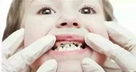 牙齿上有黑点刷不掉怎么回事,2岁宝宝牙齿上黑点刷不掉怎么办