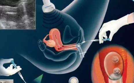 试管婴儿移植后会出现什么现象,试管婴儿移植成功率