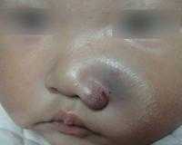 海绵状血管瘤如何正确护理？