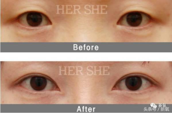 为什么开眼角会变漂亮,为什么开眼角很奇怪