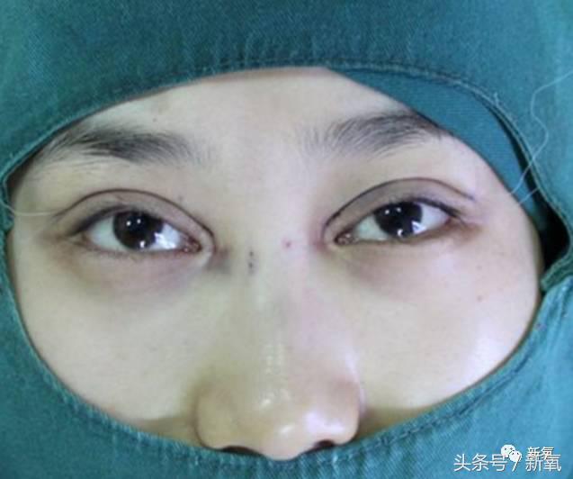 为什么开眼角会变漂亮,为什么开眼角很奇怪