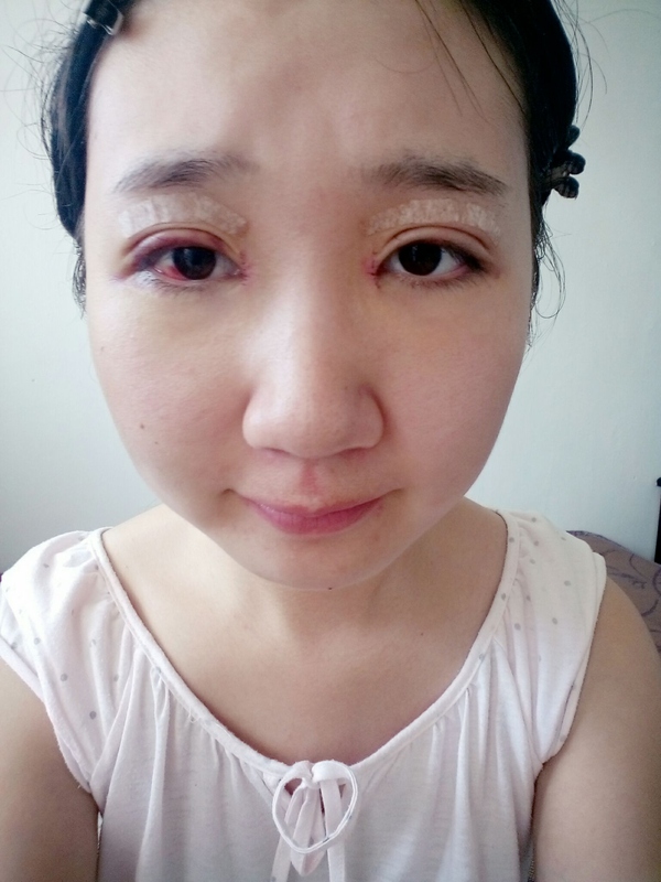 双眼皮全切手术恢复期,全切双眼皮恢复期眼尾分叉正常吗