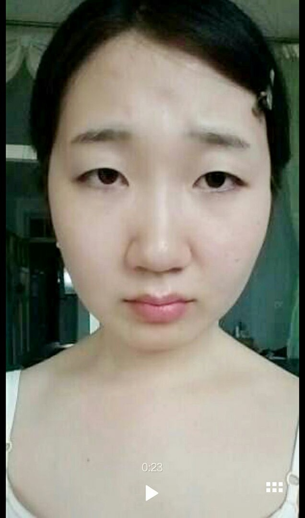 双眼皮全切手术恢复期,全切双眼皮恢复期眼尾分叉正常吗