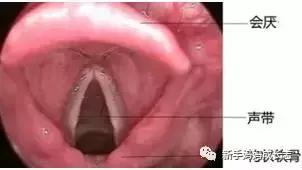 宝宝得喉骨软化症怎么治疗,婴儿喉软化1型能自愈吗