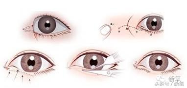 为什么开眼角会变漂亮,为什么开眼角很奇怪