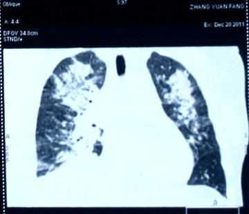 酒精中毒引起的末梢神经炎怎么治,酒精中毒要怎么治