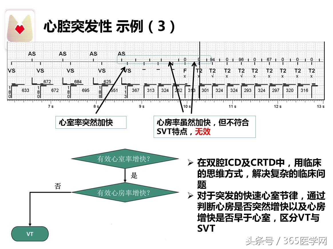 许静：新技术避免ICD不恰当放电