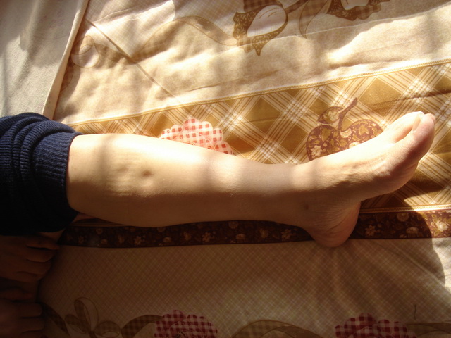 中老年人腿肿了，赶快查查有没有在服这些药