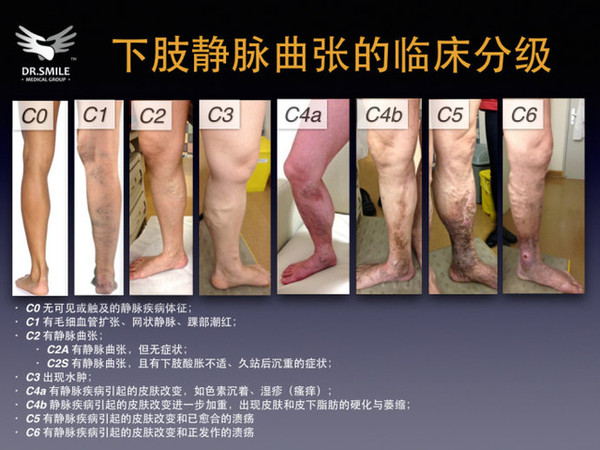 静脉曲张大出血抢救几率,下肢静脉曲张出血怎么治