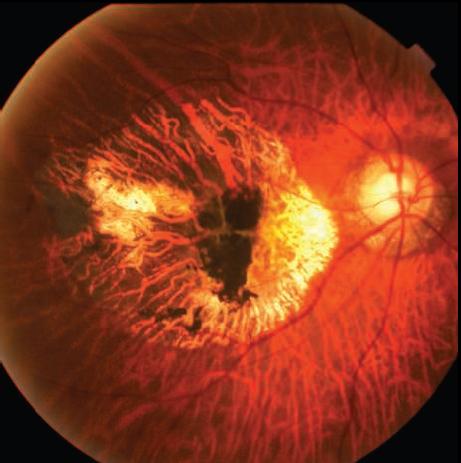 英国干细胞治疗,新英格兰医学杂志最新文章