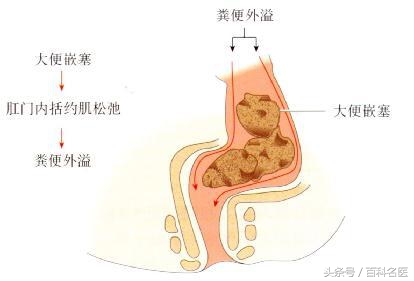 童年“屎”诗,老年“*禁失**”!如果父母大便*禁失**,你会嫌脏吗?