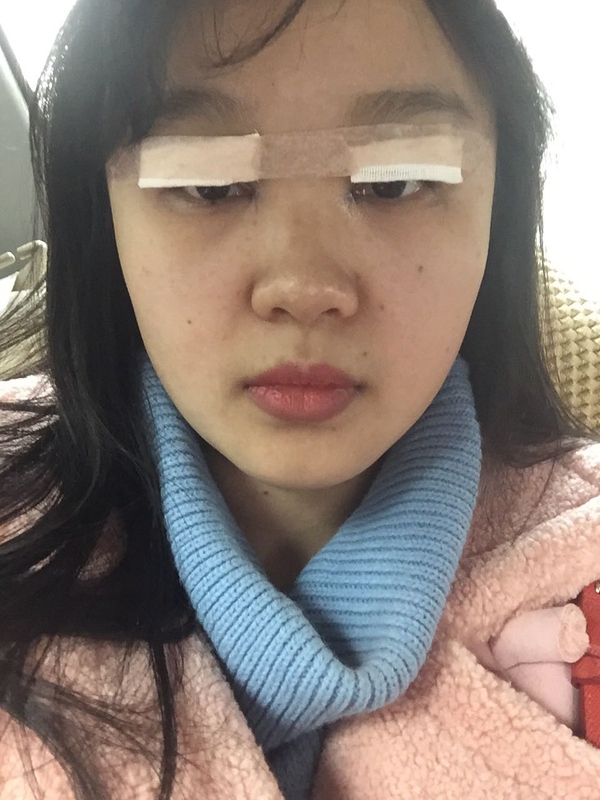 全切双眼皮感觉很窄后期会变宽嘛,内双的人割双眼皮会更自然吗