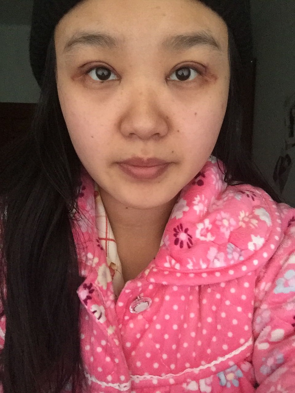 全切双眼皮感觉很窄后期会变宽嘛,内双的人割双眼皮会更自然吗