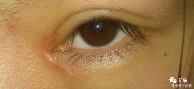 为什么开眼角会变漂亮,为什么开眼角很奇怪