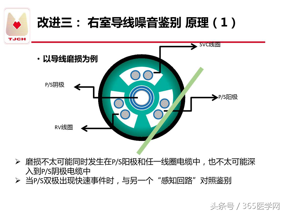 许静：新技术避免ICD不恰当放电