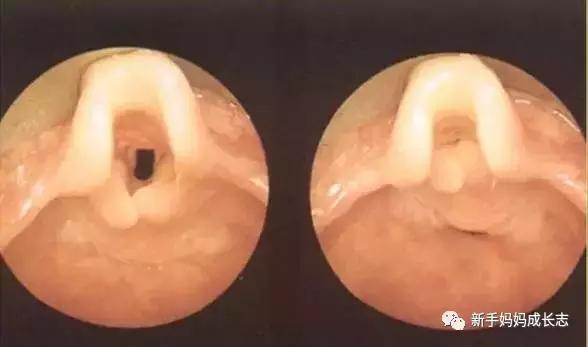 宝宝得喉骨软化症怎么治疗,婴儿喉软化1型能自愈吗