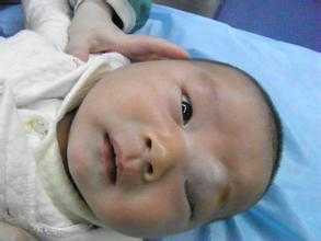 海绵状血管瘤如何正确护理？