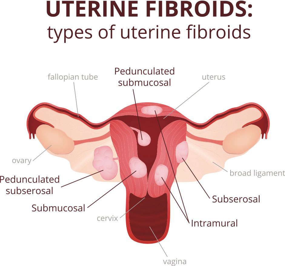 子宫肌瘤、息肉和卵巢囊肿,分别离癌症有多远?