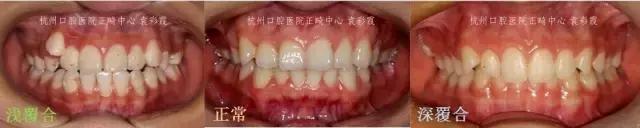 龅牙深覆合矫正效果,26岁了深覆合龅牙还能矫正吗