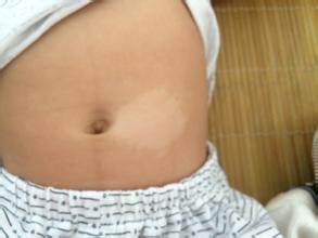 白癜风能带孩子吗,白癜风可以要宝宝吗