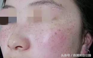 皮秒激光操作视频过程,皮秒为什么会反黑