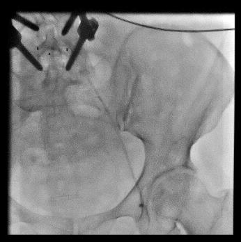 下肢肿胀有效的治疗手段是什么？