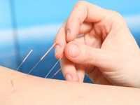 美国医师学会:针灸推荐为治疗急慢性腰痛的唯一一线疗法