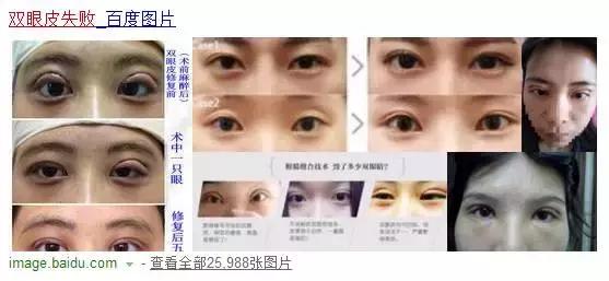 割一个双眼皮去哪做修复,修复3000块的双眼皮你敢做吗