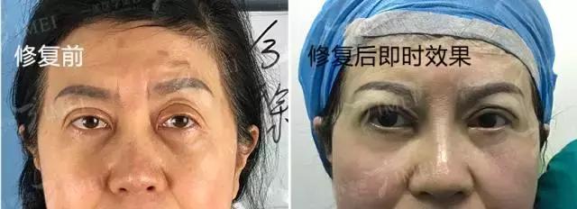 割一个双眼皮去哪做修复,修复3000块的双眼皮你敢做吗