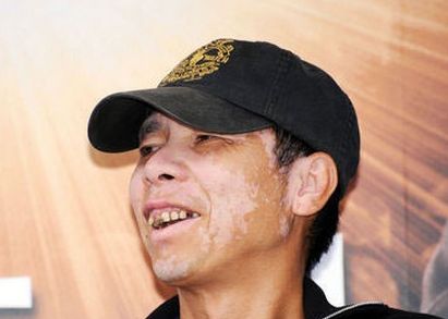 看白癜风,现在有没有什么好方法治疗白癜风