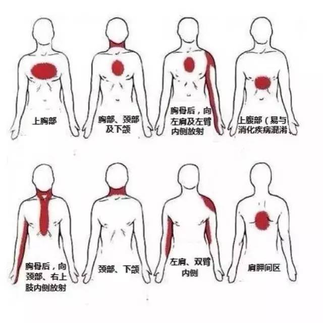 揭秘心绞痛症状,心绞痛的症状及自查六大细节