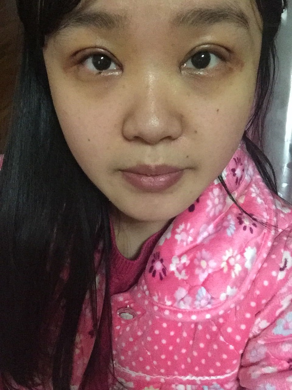 全切双眼皮感觉很窄后期会变宽嘛,内双的人割双眼皮会更自然吗