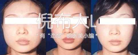 打完瘦脸针后如何维持瘦脸效果,打了瘦脸针脸上的肉会变多吗