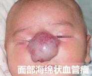 海绵状血管瘤如何正确护理？