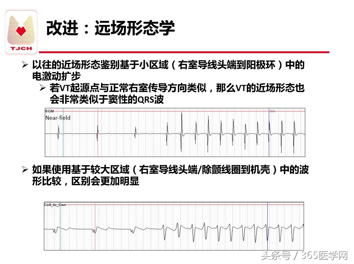 许静：新技术避免ICD不恰当放电