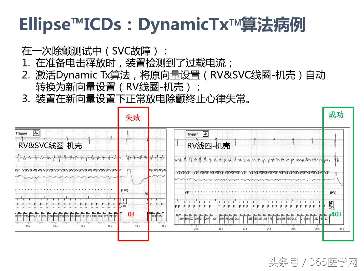 许静：新技术避免ICD不恰当放电