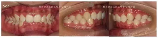 龅牙深覆合矫正效果,26岁了深覆合龅牙还能矫正吗