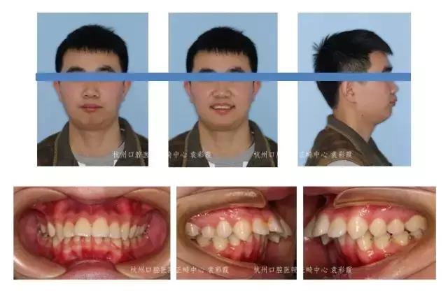 龅牙深覆合矫正效果,26岁了深覆合龅牙还能矫正吗