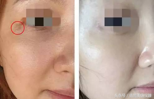 皮秒激光操作视频过程,皮秒为什么会反黑