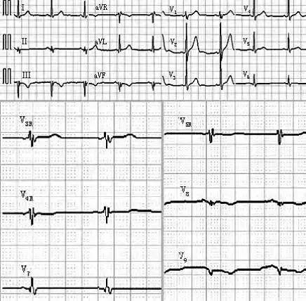 学会看心电图的书,阅读心电图的步骤