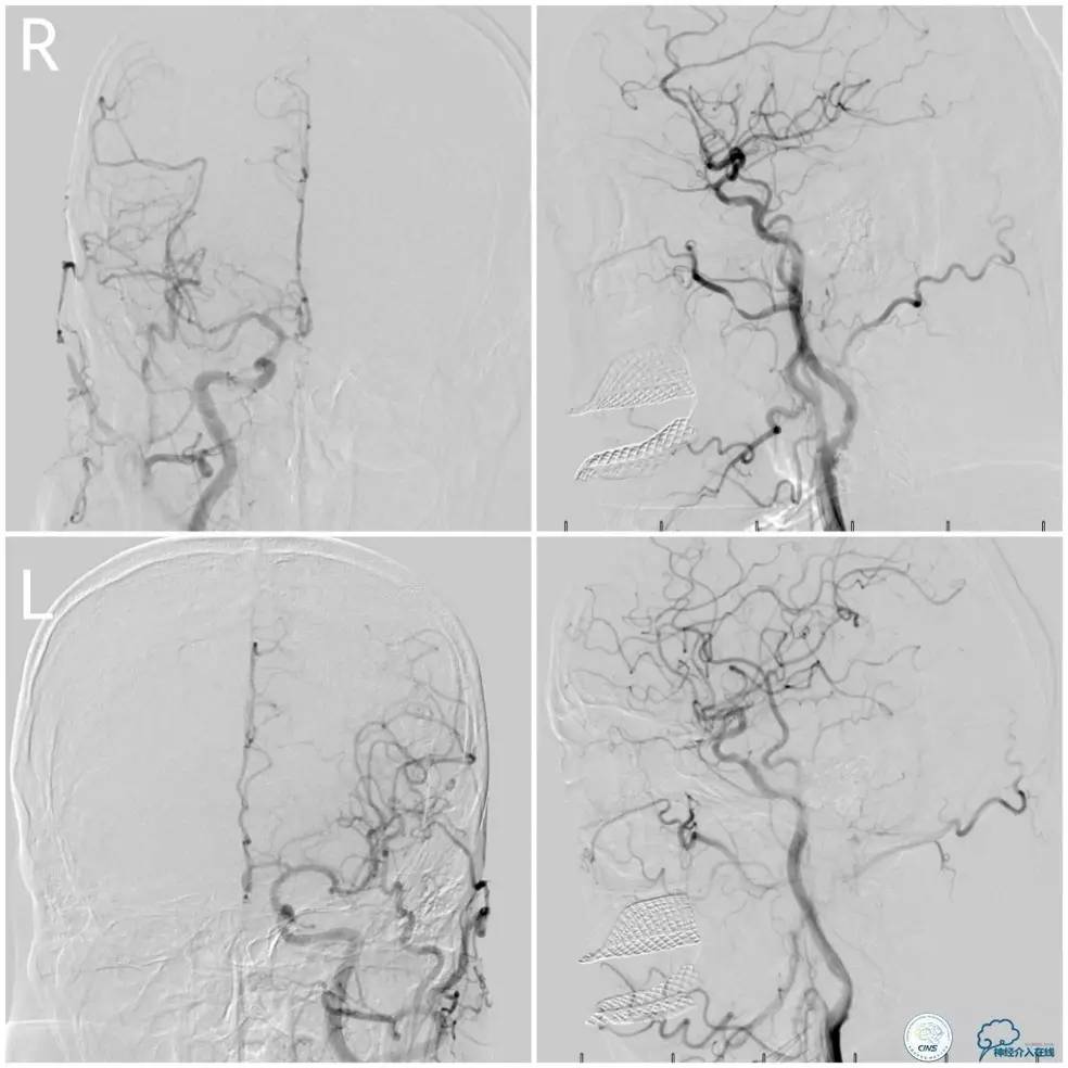 天坛周记｜右椎动脉V1段及V4-基底动脉串联病变支架治疗一例