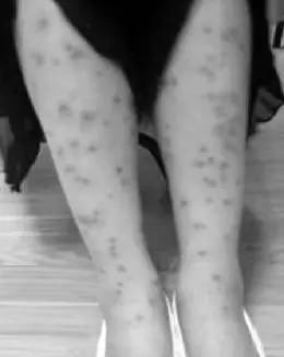 蠓虫不吸血怎么活,蠓虫最怕什么怎么防